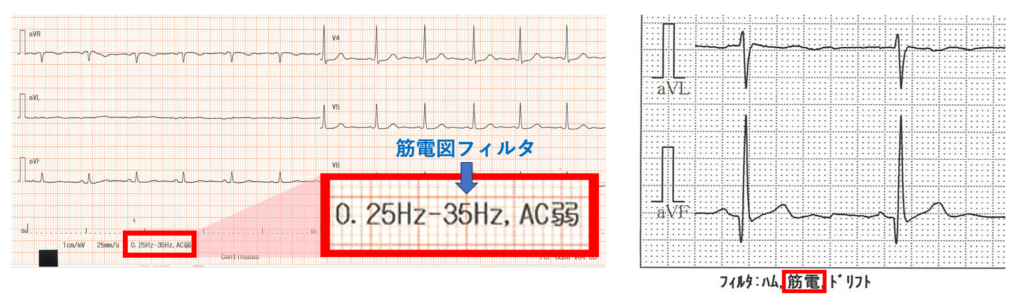 筋電図(electromyogram)