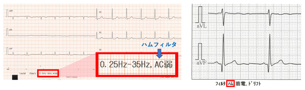 交流障害(powerline interference, hum)