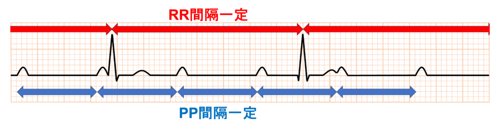 完全房室ブロック(complete atrioventricular block)
