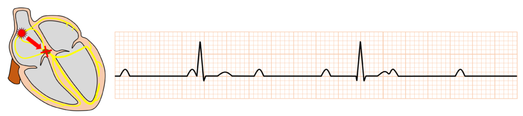 完全房室ブロック(complete atrioventricular block)