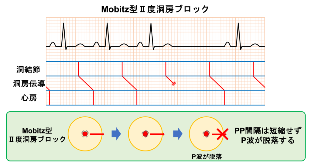 洞房ブロック(sinoatrial block)
