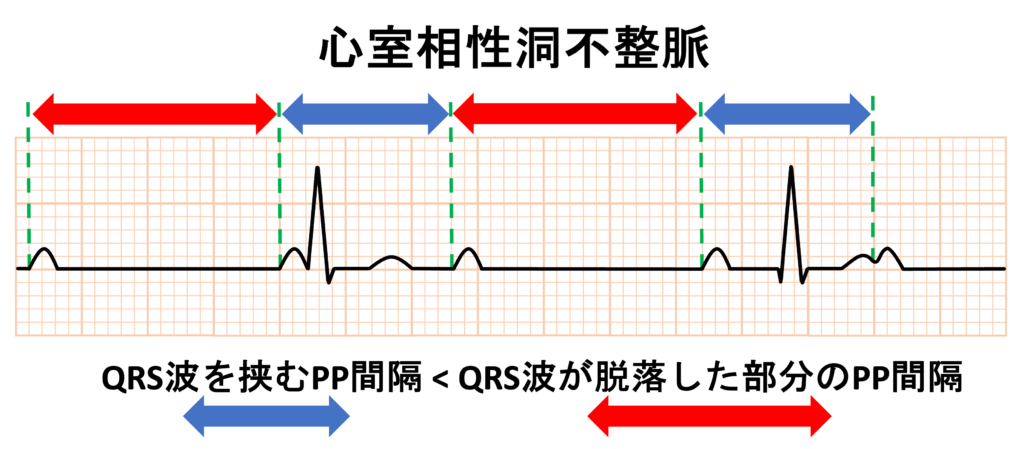 完全房室ブロック(complete atrioventricular block)