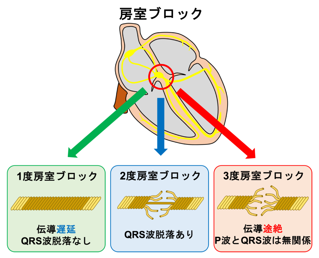 完全房室ブロック(complete atrioventricular block)