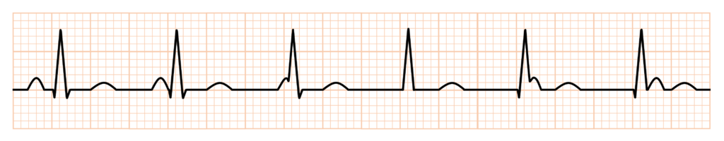 等頻度房室解離
完全房室ブロック(complete atrioventricular block)
