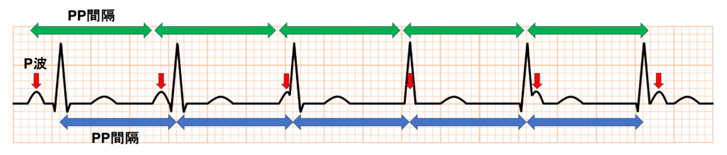 等頻度房室解離
完全房室ブロック(complete atrioventricular block)