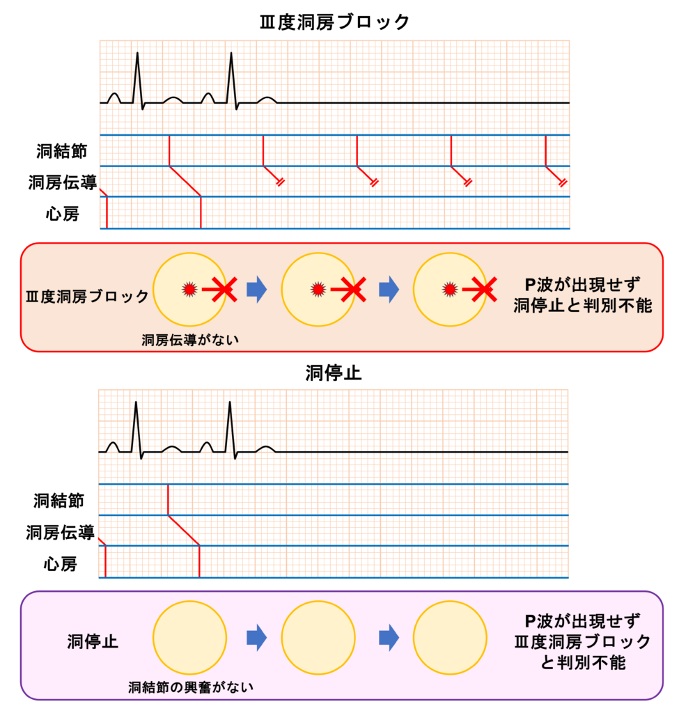 洞房ブロック(sinoatrial block)