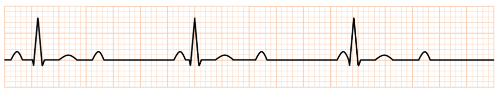 完全房室ブロック(complete atrioventricular block)
2：1房室ブロック