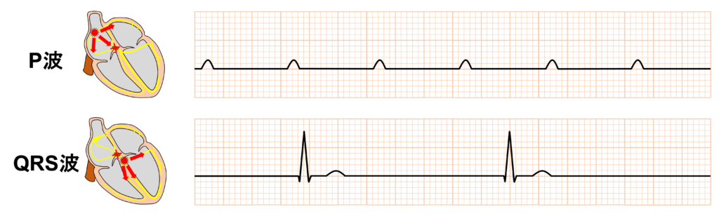 完全房室ブロック(complete atrioventricular block)