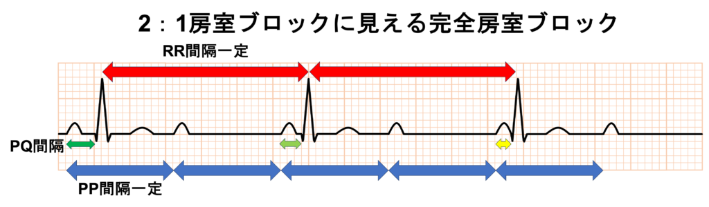 2：1房室ブロック(2：1 atrioventricular block)
完全房室ブロック