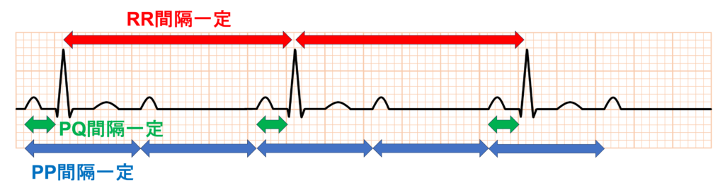 2：1房室ブロック(2：1 atrioventricular block)