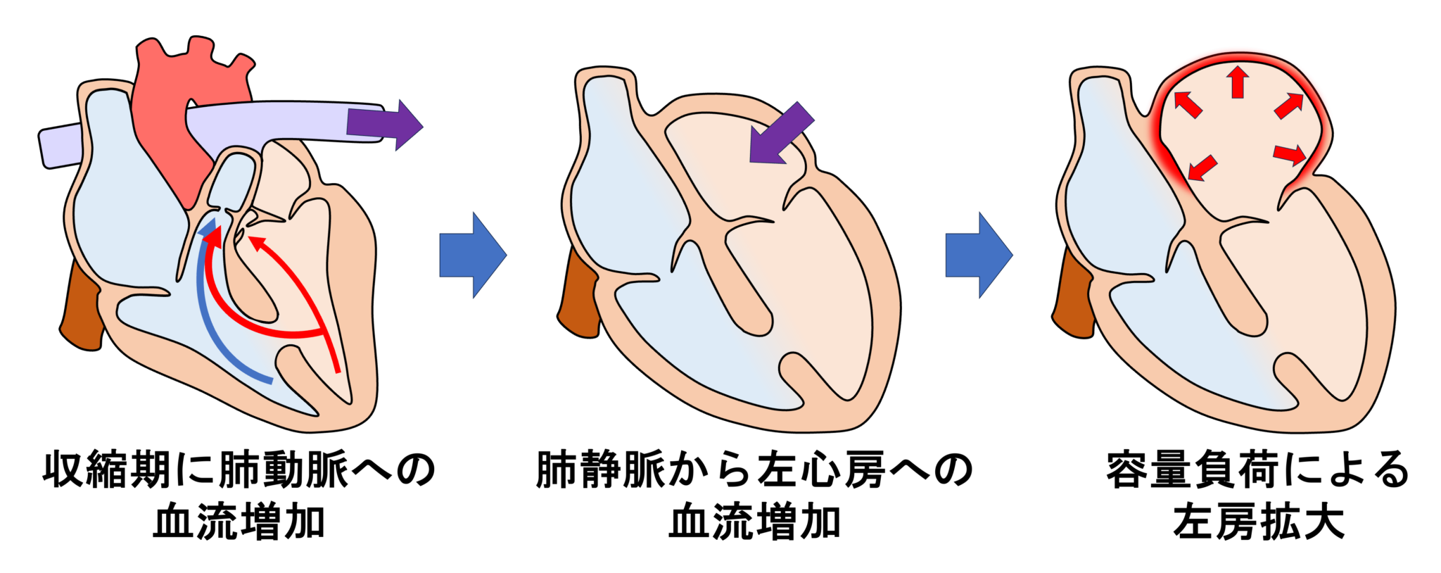 心室中隔欠損症とは? | 心電図.com