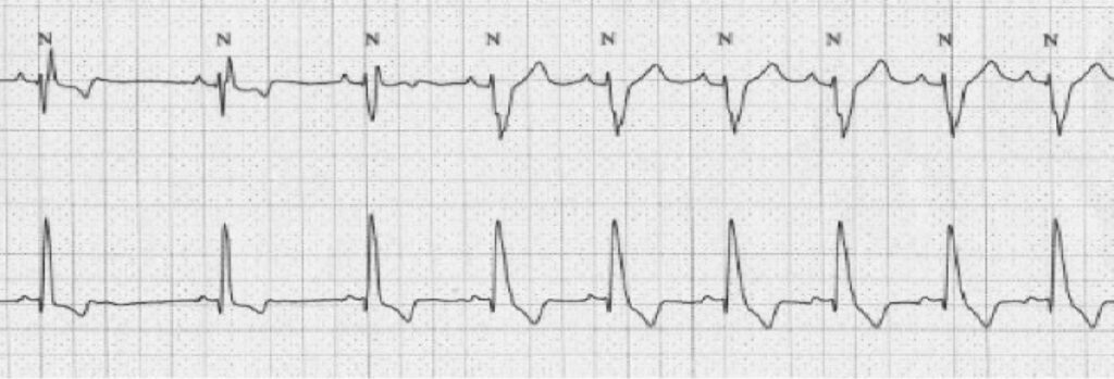 頻脈依存性脚ブロック(Tachycardia-dependent bundle branch block)