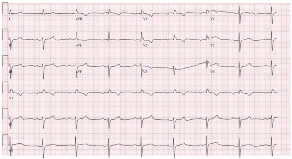 仮装脚ブロック(masquerading bundle branch block)