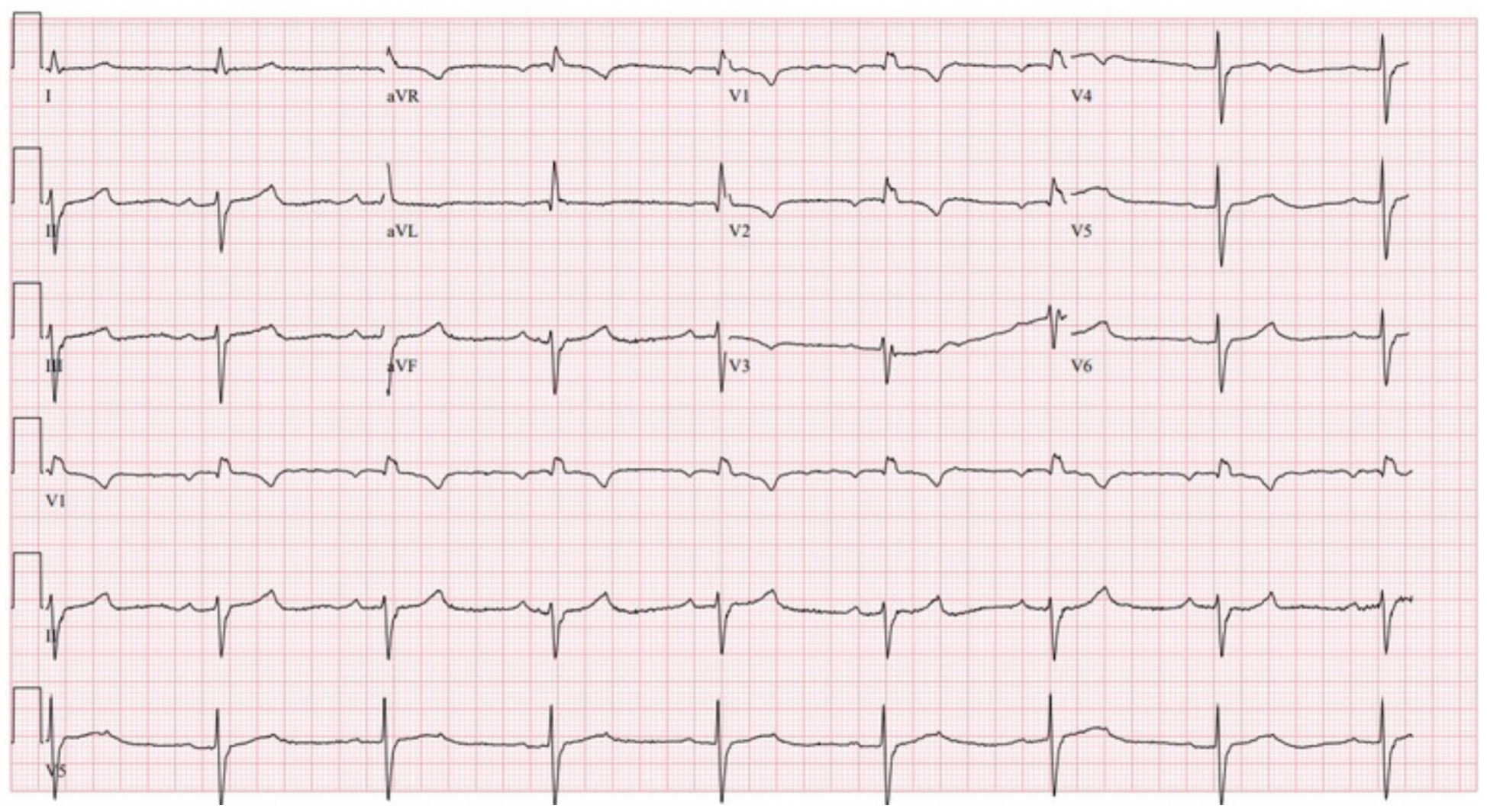 仮装脚ブロック(masquerading bundle branch block)