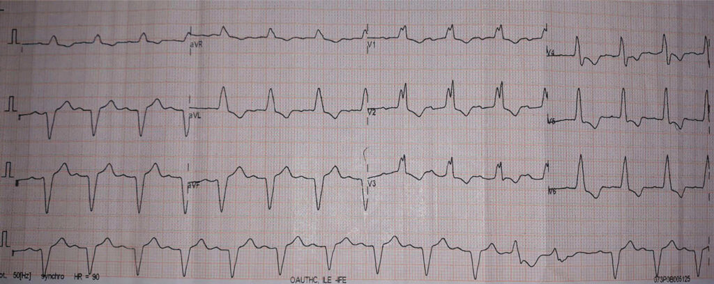 仮装脚ブロック(masquerading bundle branch block)