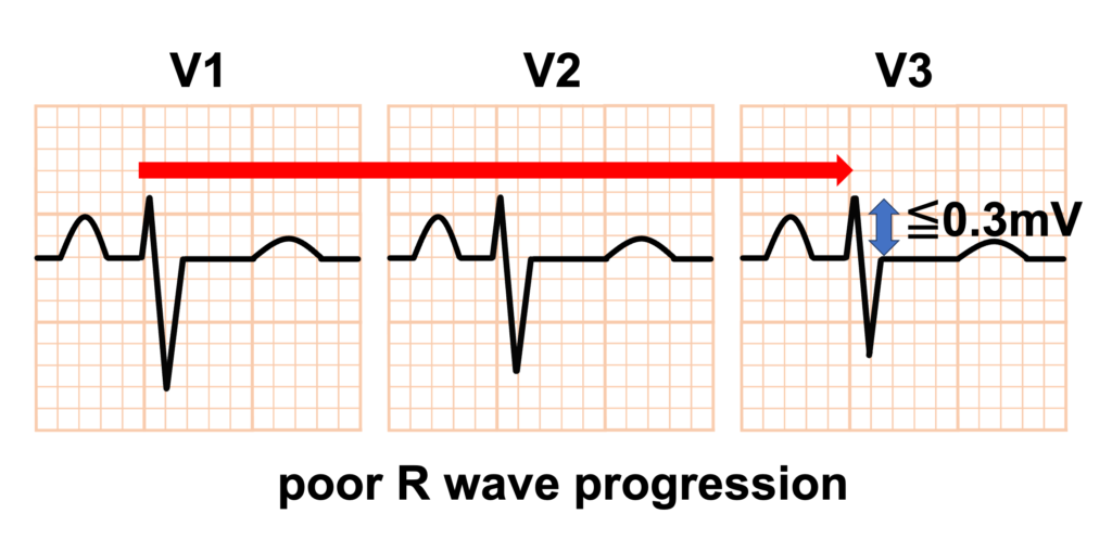 poor R wave progression