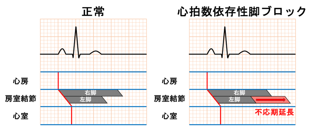 頻脈依存性脚ブロック(Tachycardia-dependent bundle branch block)