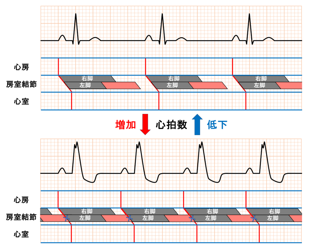 頻脈依存性脚ブロック(Tachycardia-dependent bundle branch block)