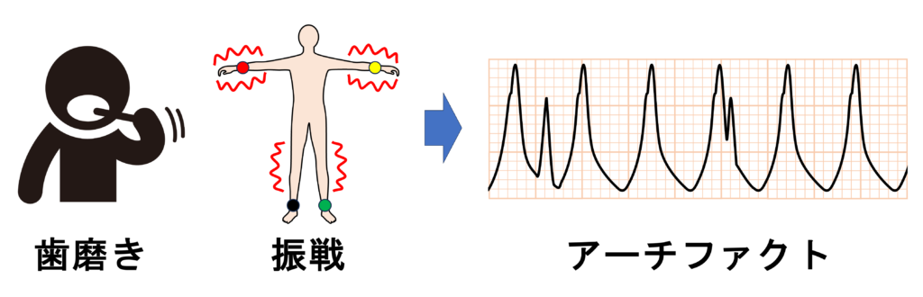 notch signとは？