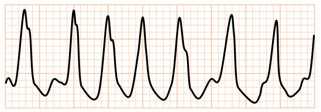 心室頻拍(Ventricular Tachycardia)