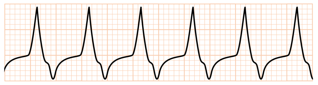 心室頻拍(Ventricular Tachycardia)