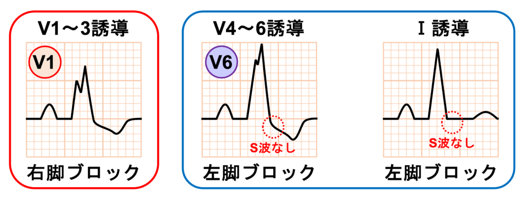 仮装脚ブロック(masquerading bundle branch block)