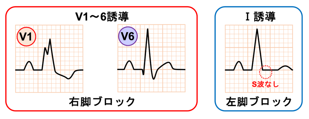 仮装脚ブロック(masquerading bundle branch block)