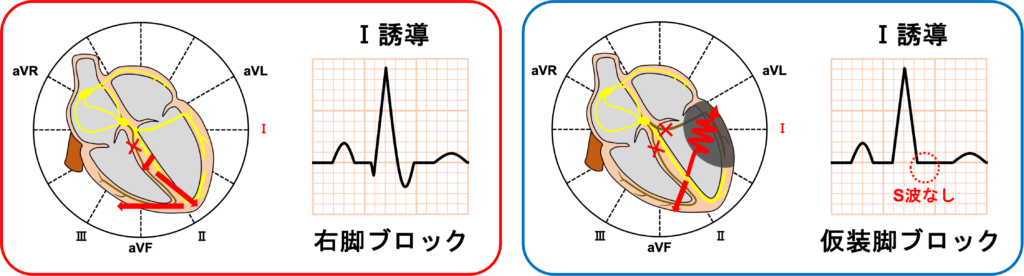 仮装脚ブロック(masquerading bundle branch block)