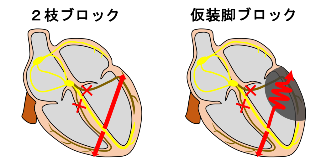 仮装脚ブロック(masquerading bundle branch block)