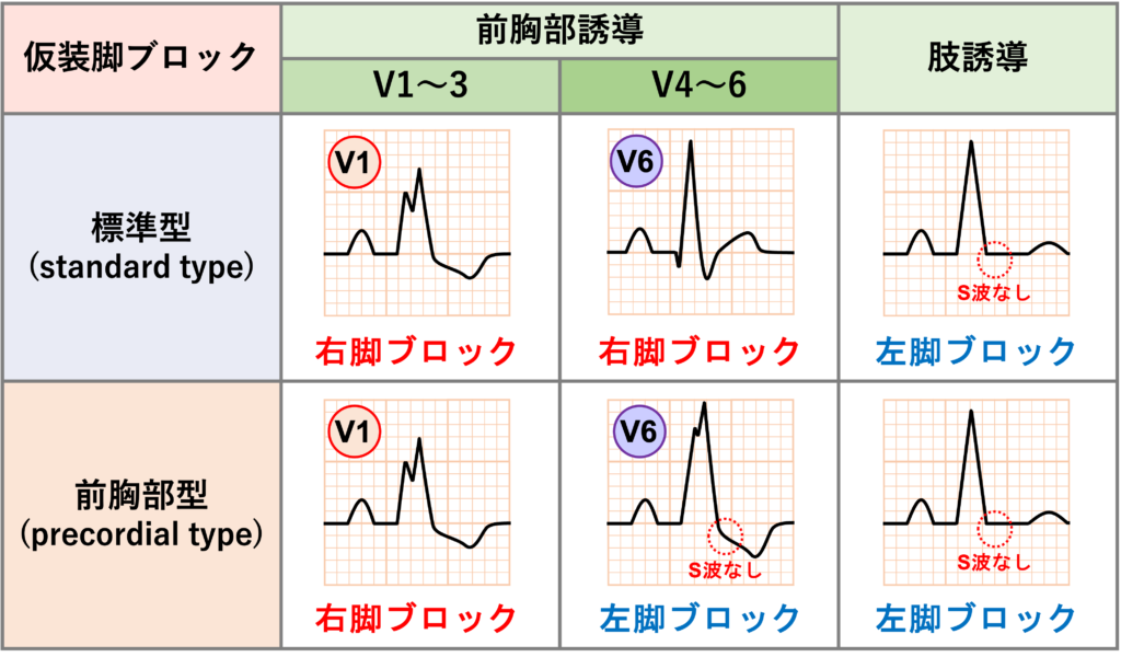 仮装脚ブロック(masquerading bundle branch block)