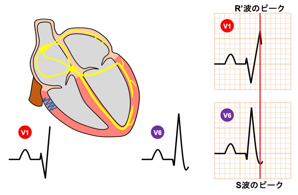 右脚ブロック(right bundle branch block：RBBB)