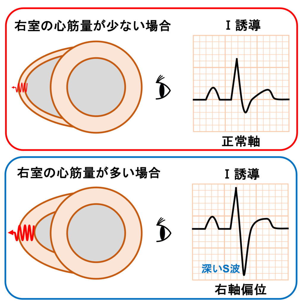 右脚ブロック(right bundle branch block：RBBB)
