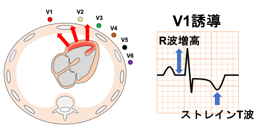 ファロー四徴症(Tetralogy of Fallot：TOF)