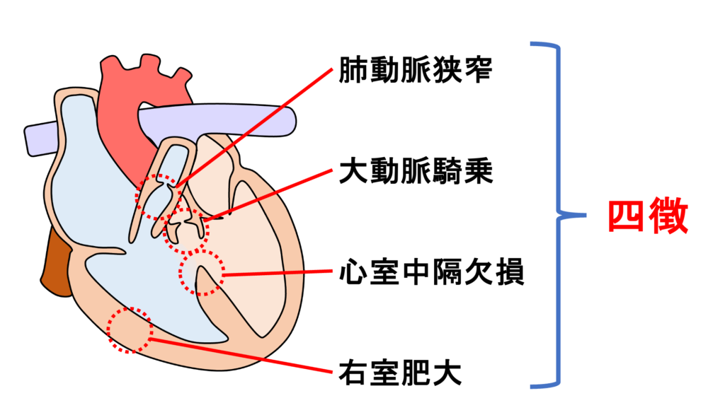 ファロー四徴症(Tetralogy of Fallot：TOF)