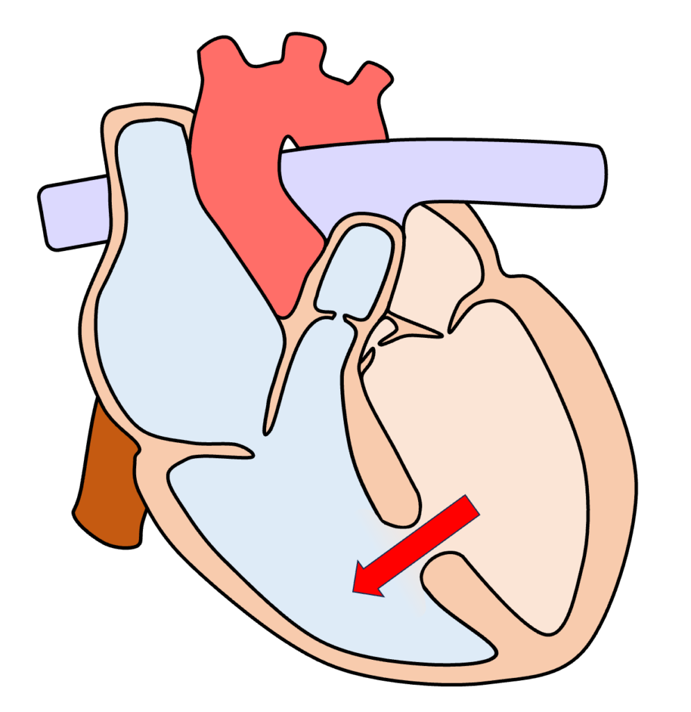 心室中隔欠損症(ventricular septal defect : VSD)