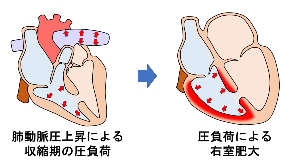 心室中隔欠損症(ventricular septal defect : VSD)