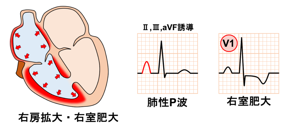 心室中隔欠損症(ventricular septal defect : VSD)