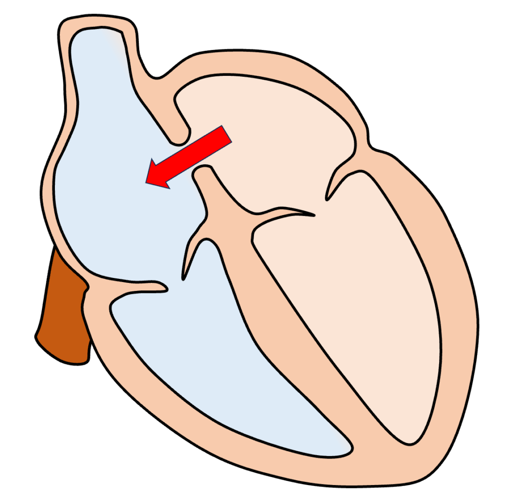 心房中隔欠損症(atrial septal defect : ASD)