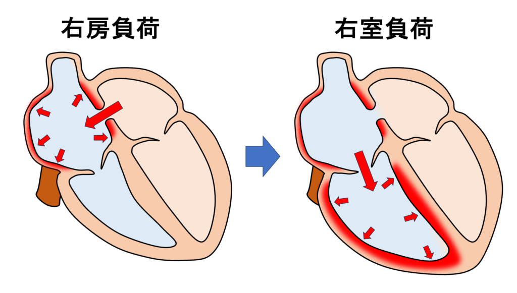 心房中隔欠損症(atrial septal defect : ASD)