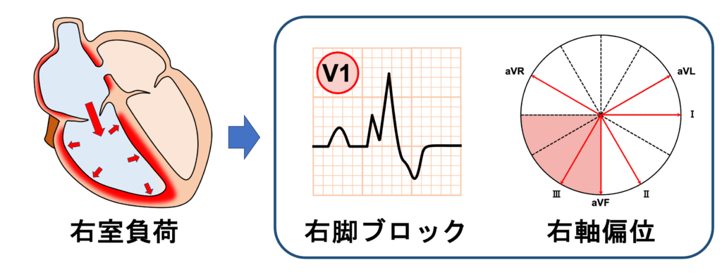 心房中隔欠損症(atrial septal defect : ASD)