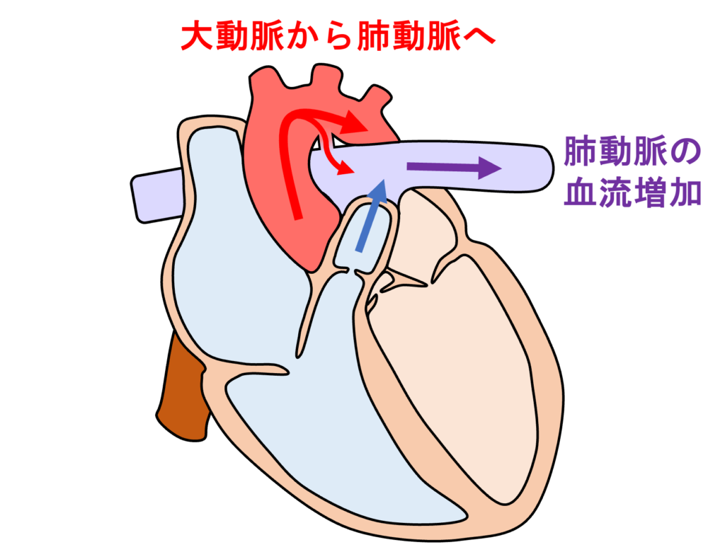 動脈管開存症(patent ductus ateriosus)