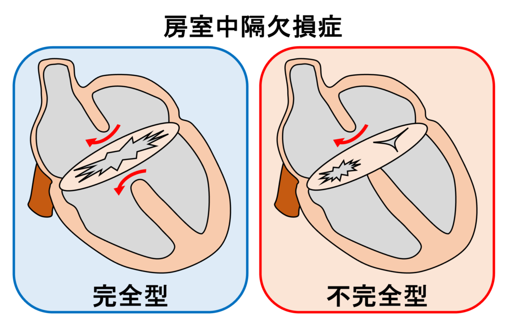 房室中隔欠損症(atrioventricular septal defect)