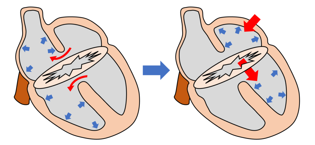 房室中隔欠損症(atrioventricular septal defect)