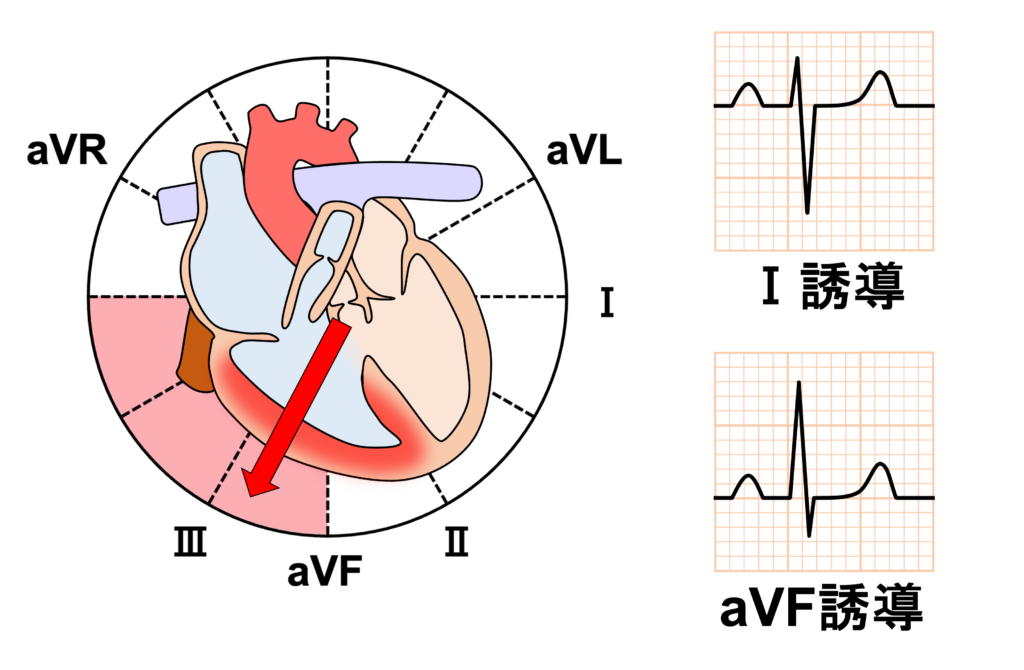ファロー四徴症(Tetralogy of Fallot：TOF)