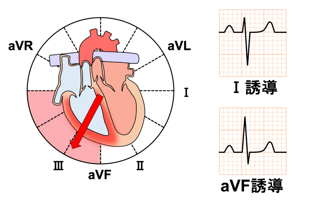 完全大血管転位(complete transposition of great arteries)