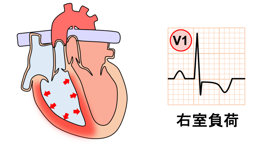 完全大血管転位(complete transposition of great arteries)