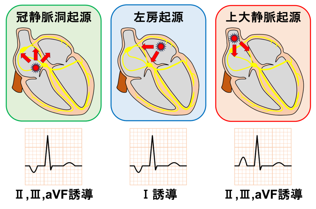 異所性心房調律(Ectopic atrial rhythm：EAR)
