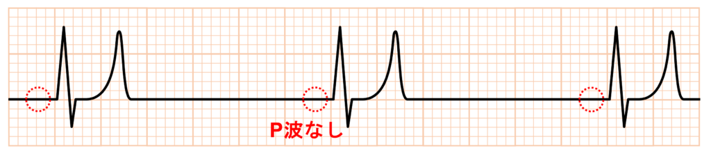 高カリウム血症(Hyperkalemia)