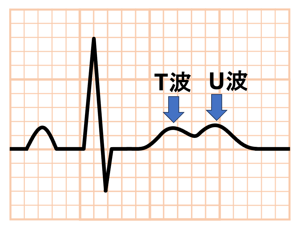 低カリウム血症(Hypokalaemia)