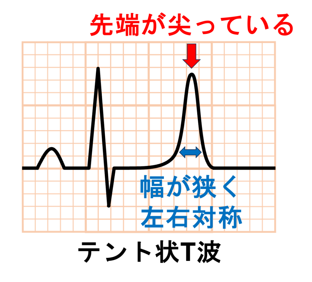 高カリウム血症(Hyperkalemia)